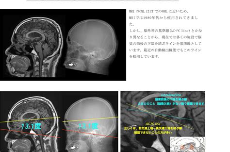 頭部七條基準線中 左側側角點連至右側側角點的是